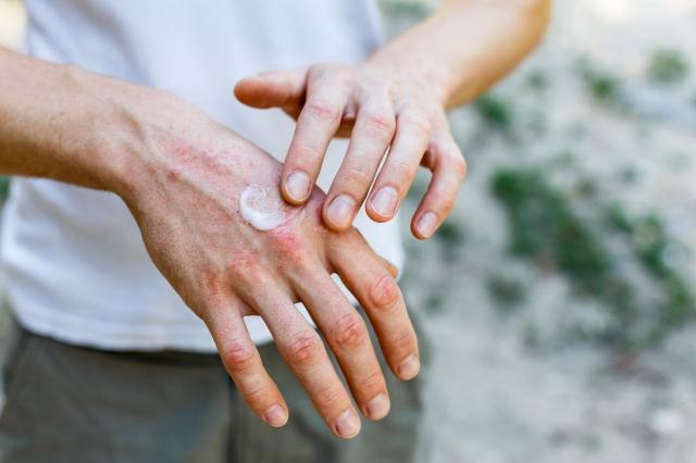 How To Find Relief Through Targeted Psoriasis Treatment cover picture