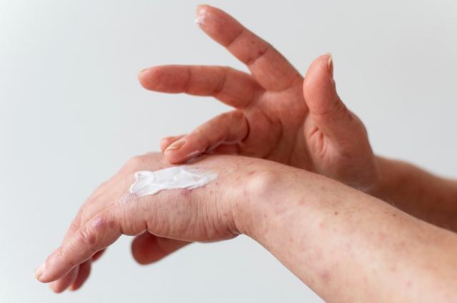 The Everyday Habits That Make Eczema Worse cover picture