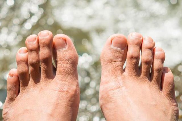 5 Key Hammertoes Facts You Need to Know cover picture