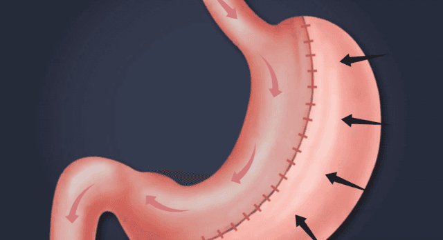 Transform Your Life: Why Gastric Sleeve Surgery in Gold Coast Is Worth Considering cover picture