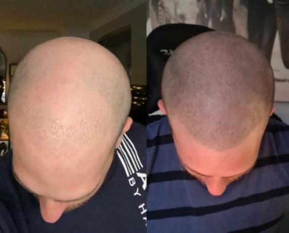 Scalp Micropigmentation: A Breakthrough Technique cover picture