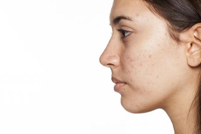 Discover All You Need to Know About Pimples cover picture