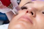 The Benefits Of Microneedling And Some AfterCare Tips cover picture