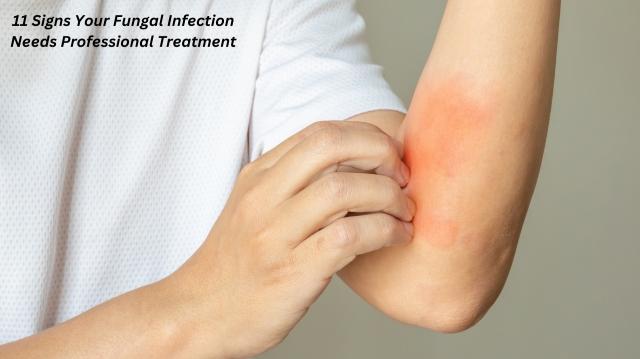 11 Signs Your Fungal Infection Needs Professional Treatment cover picture
