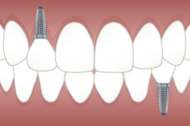 Transform Your Smile: The Power of Dental Implants cover picture