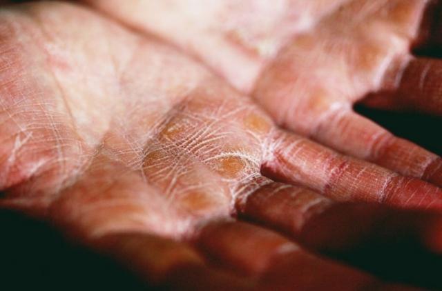 Effective Treatments and Daily Care Tips for Managing Eczema cover picture