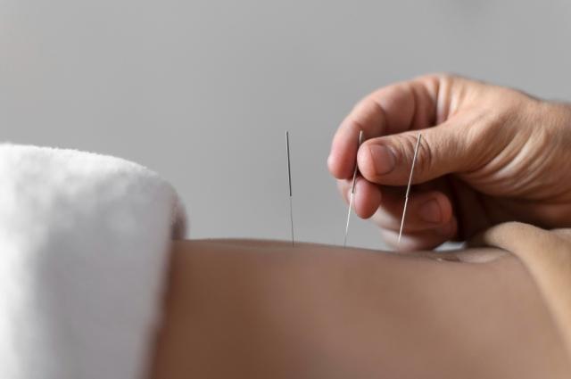 The Fastest Way to Become an Acupuncturist cover picture