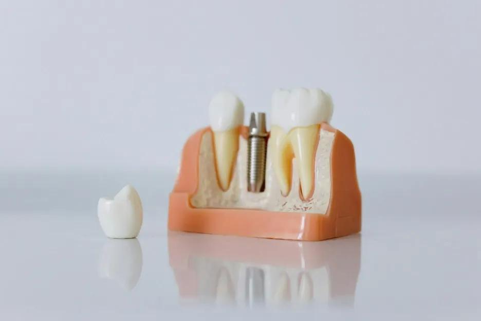 Why Dental Implants Are Essential for Bone Health cover picture