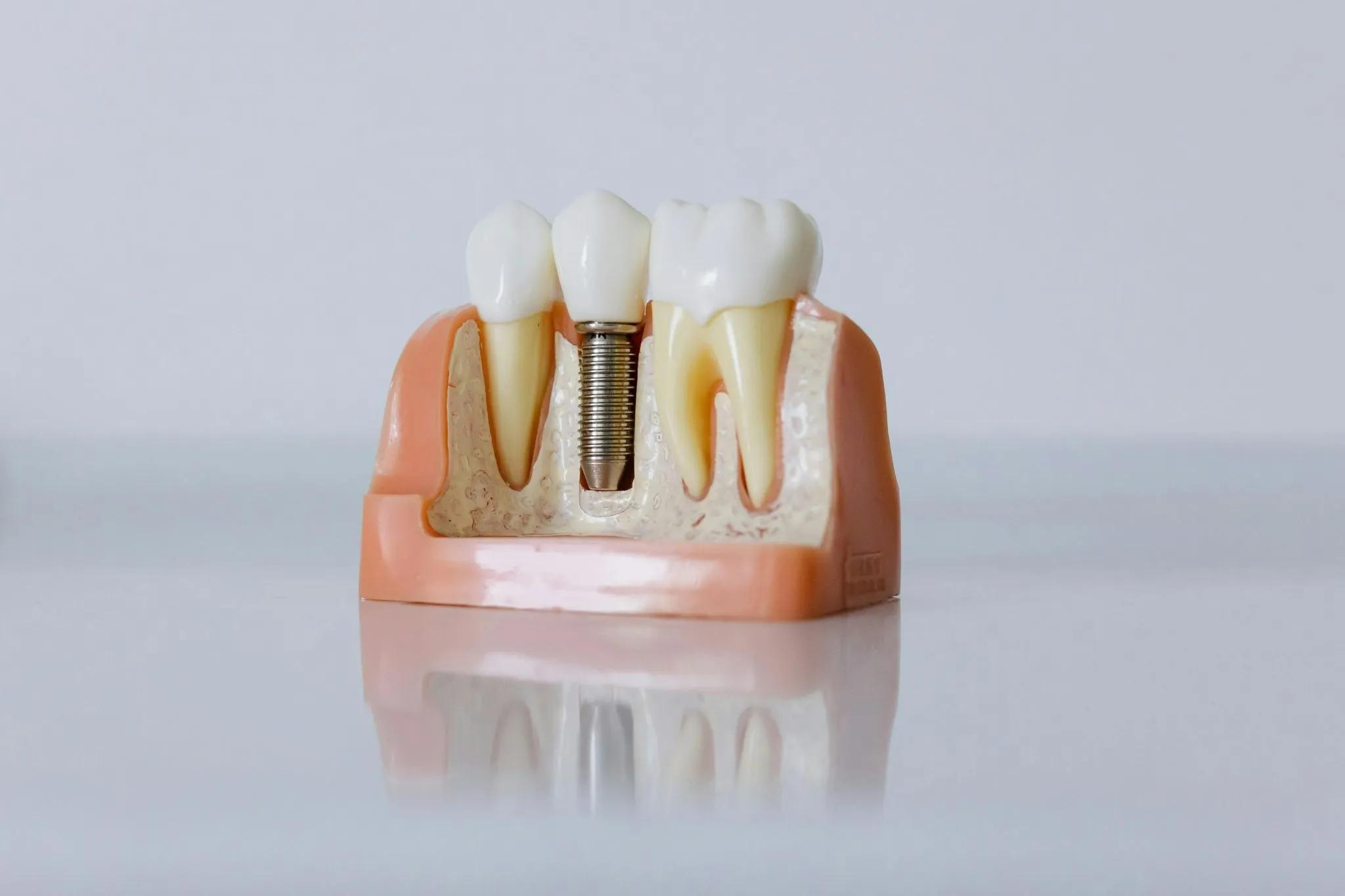 Dental Implants and Quality of Life: Benefits Beyond Aesthetics cover picture