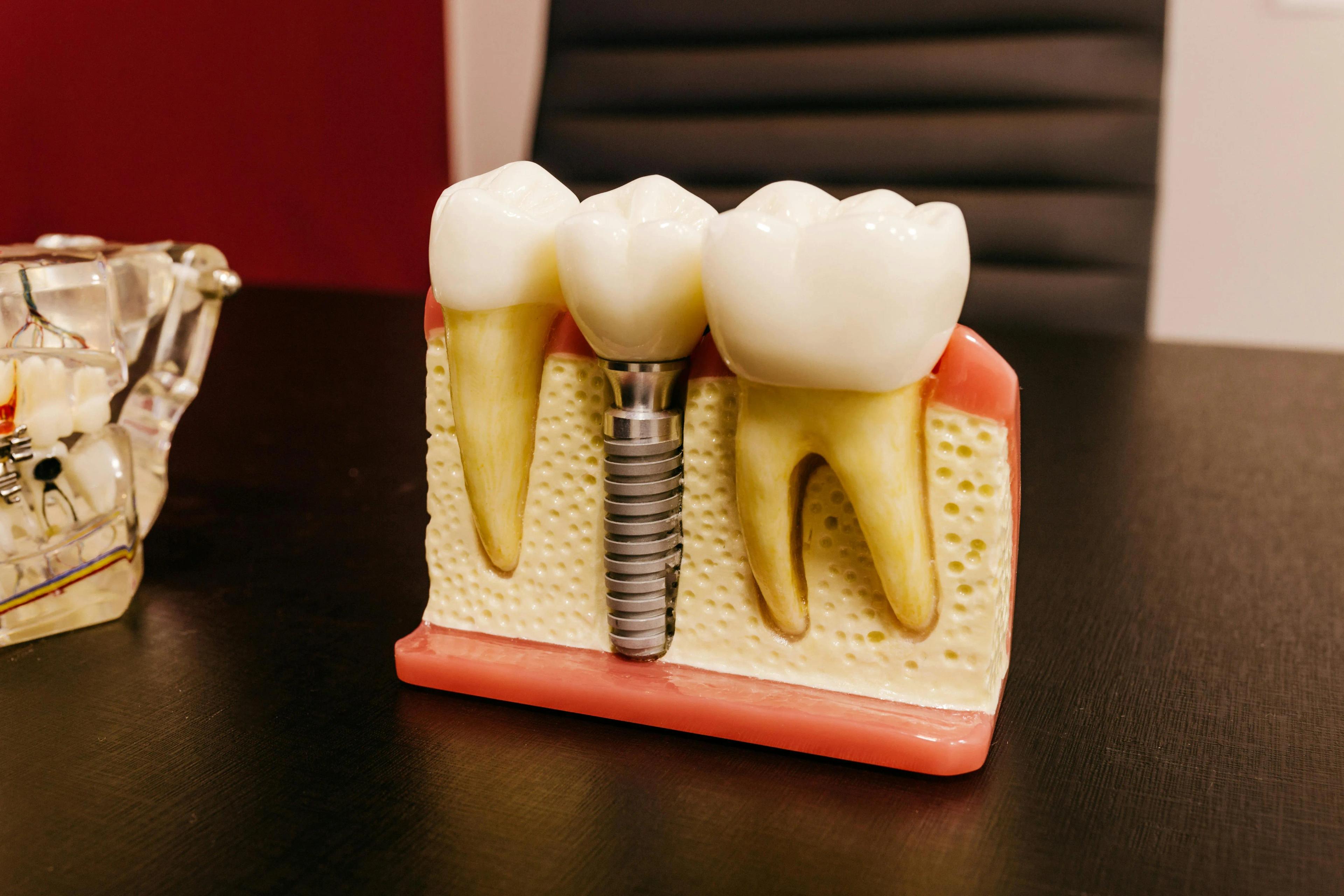 Dental Implants: Recovery Tips for Faster Healing cover picture
