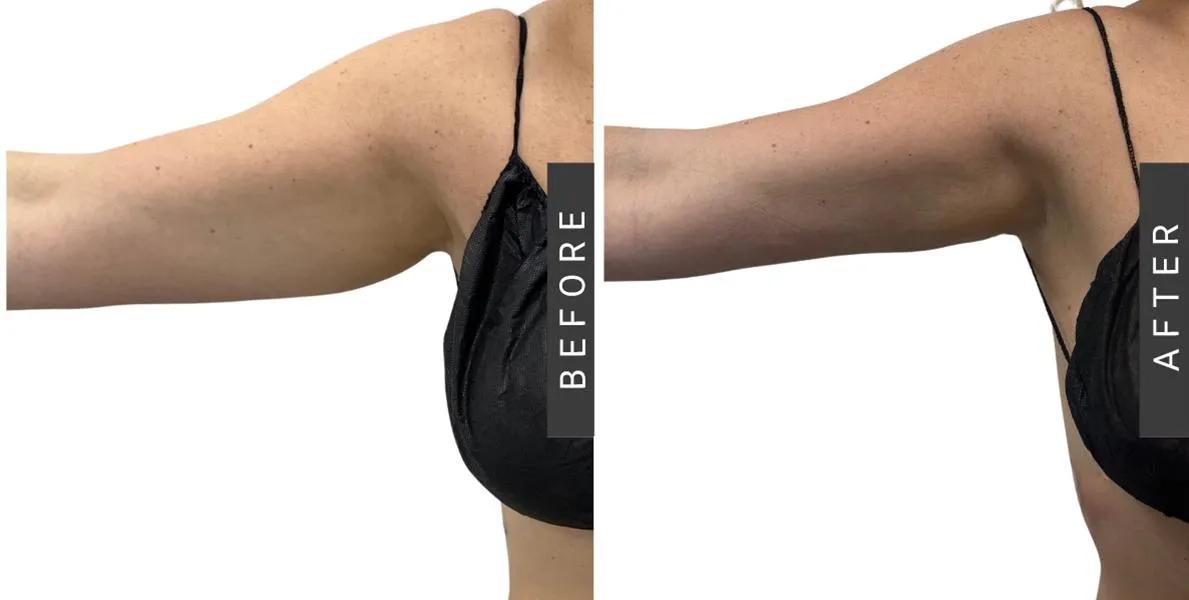 Liposuction: Targeted Fat Removal for a More Sculpted, Balanced Body cover picture