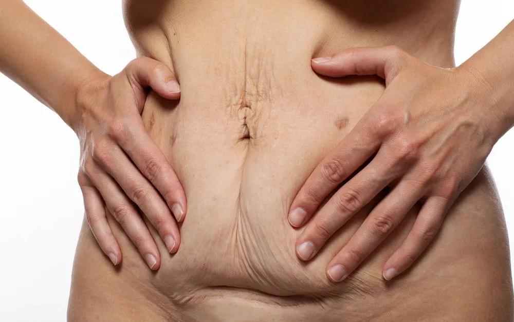 How Much Loose Skin Can a Tummy Tuck Remove & Who is a Good Candidate? cover picture