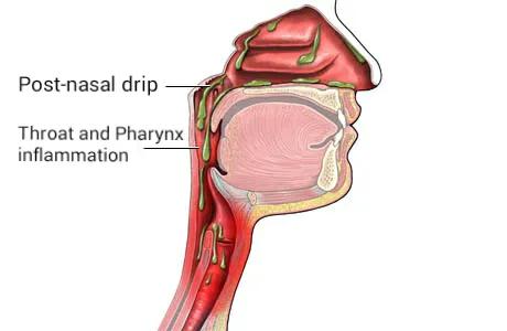 What treatments are recommended when post nasal drip cough is caused by acid reflux? cover picture