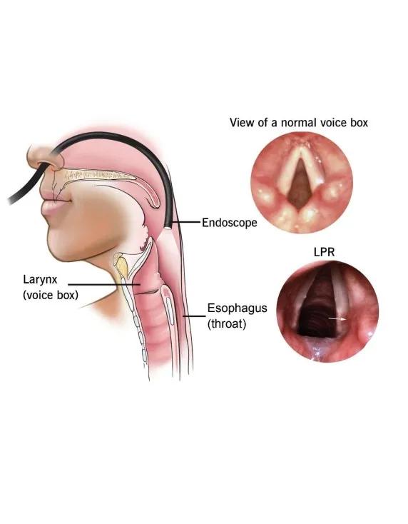 Why Does Acid Reflux Cause a Sore Throat and How Can You Tell the Difference? cover picture