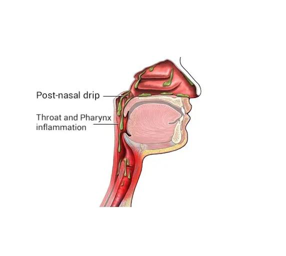 How Long Does Post Nasal Cough Last and Which Treatments Help Fastest? cover picture