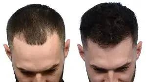 Hair Transplant No Finasteride cover picture