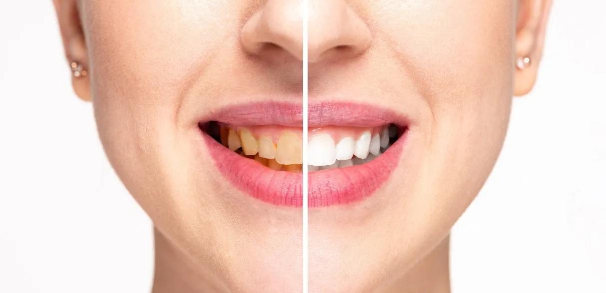 Teeth Whitening at the Dentist: Why Professional Care Gives Better Results cover picture