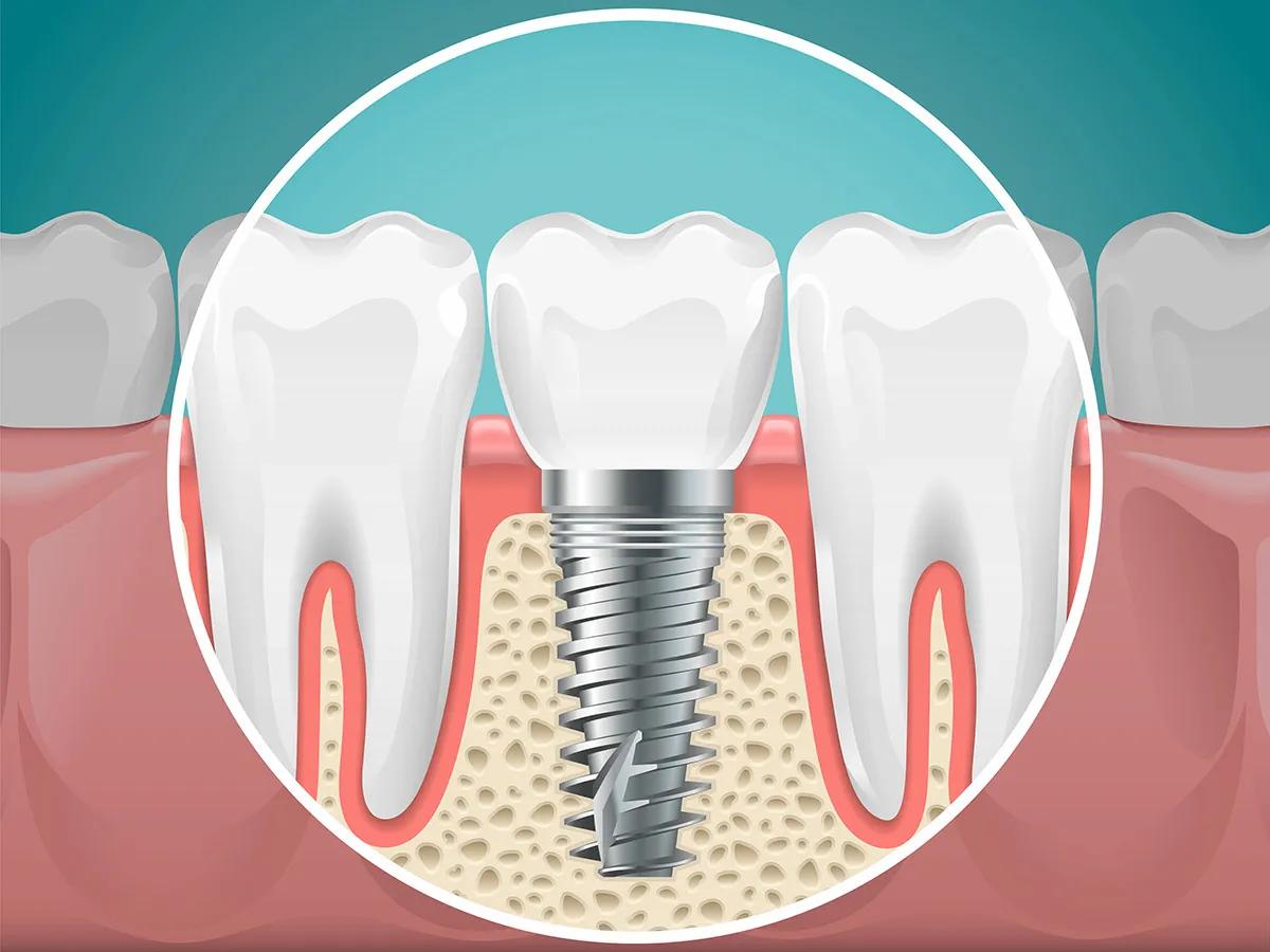 Common Myths About Dental Implants That Confuse Patients cover picture