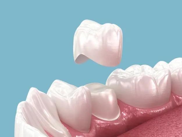 Dental Crowns vs. Bridges: Key Differences Every Patient Should Know! cover picture