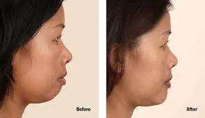 Chin Augmentation Surgery: What You Need to Know Before Enhancing Your Profile cover picture