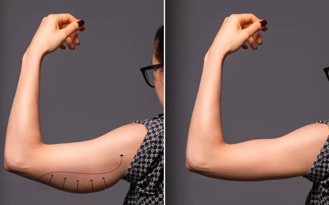 Brachioplasty San Diego: Achieve Toned, Confident Arms with Iconic Plastic Surgery cover picture