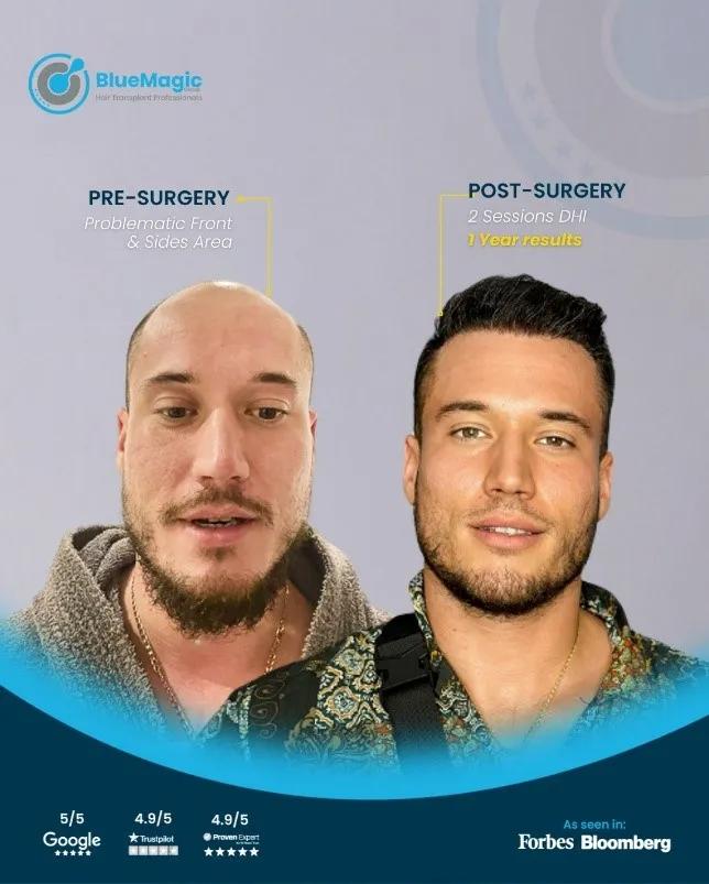 How to Choose the Best Hair Transplant in Turkey cover picture