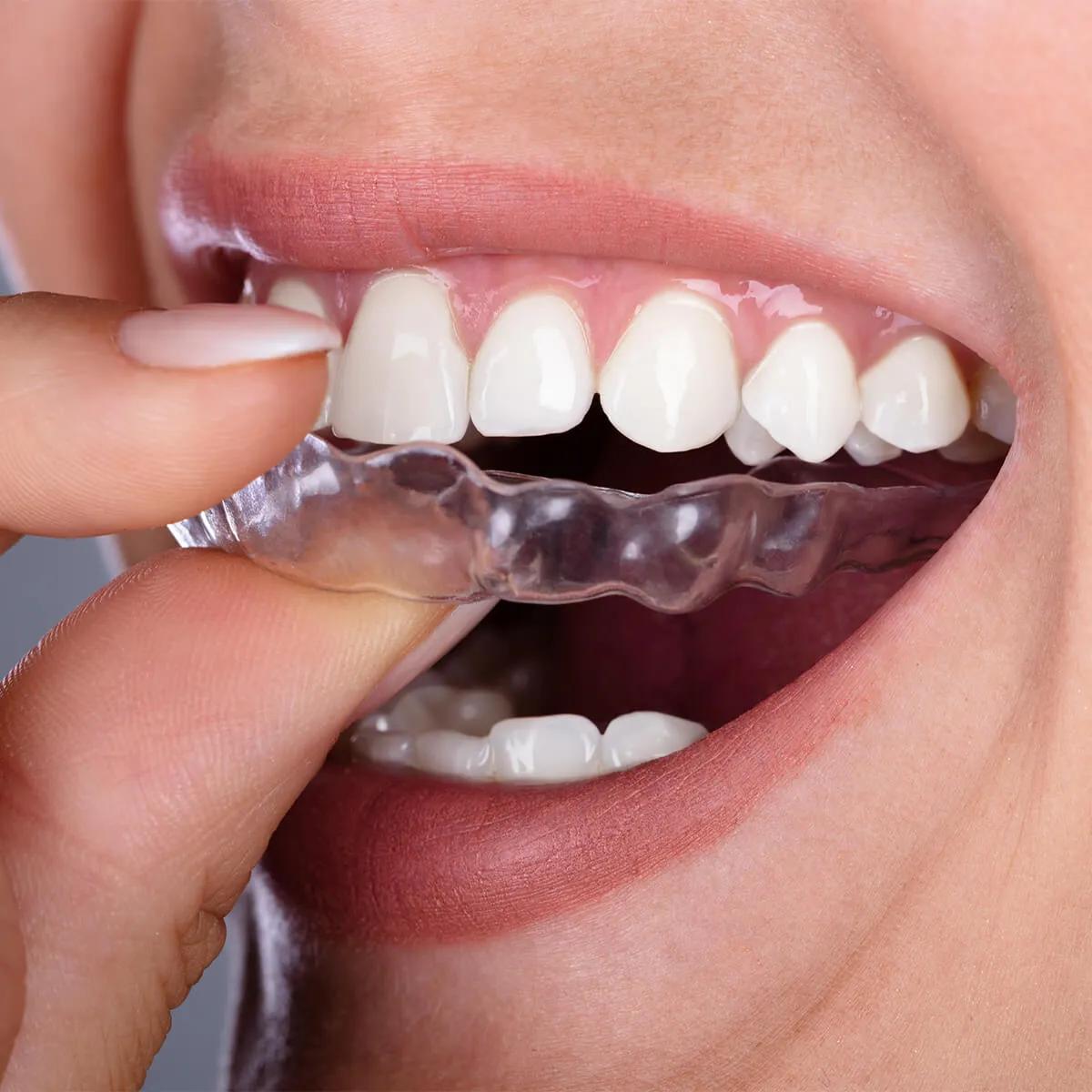 Where can I find affordable Invisalign in Brookfield? cover picture