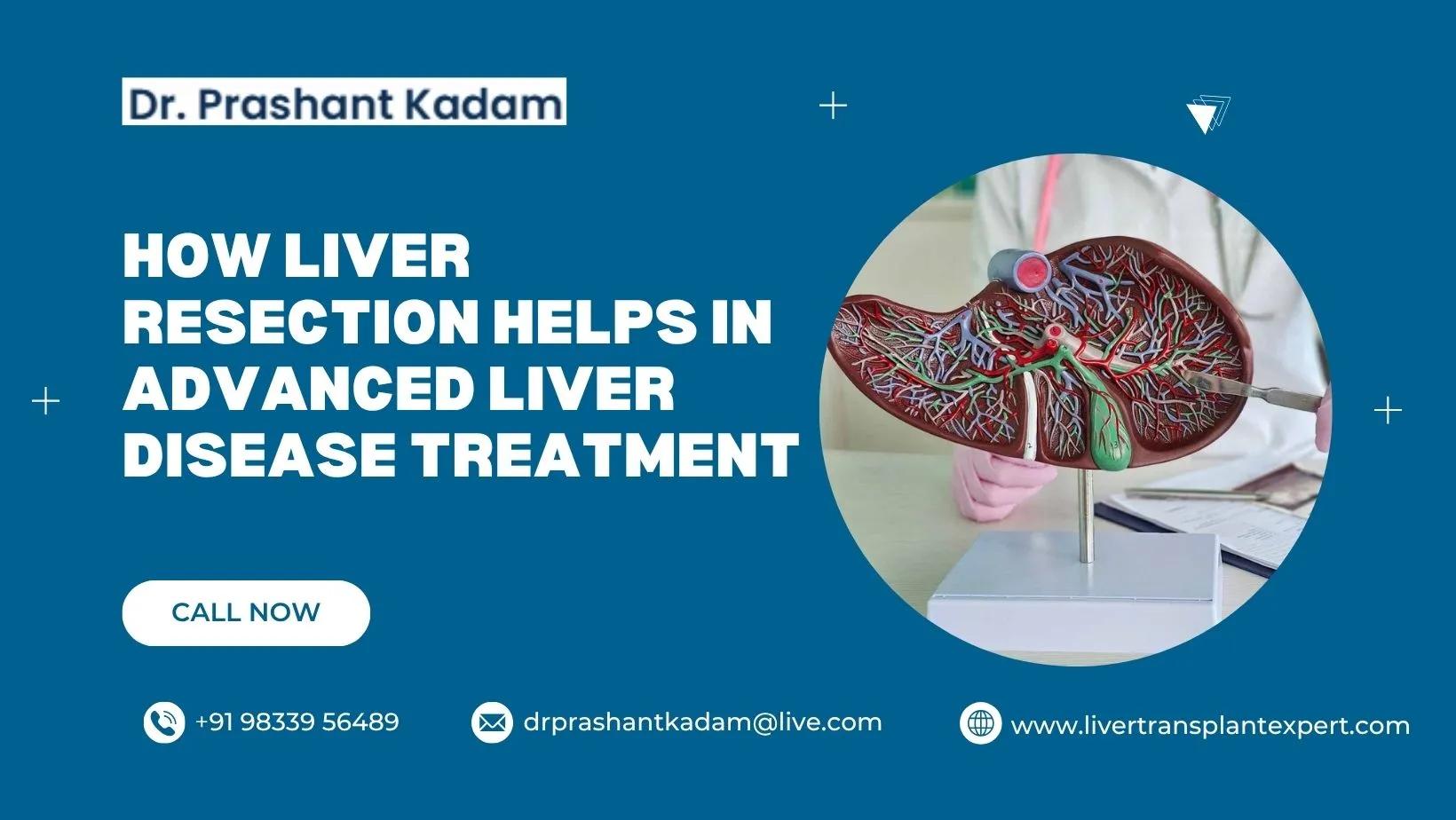 How Liver Resection Helps in Advanced Liver Disease Treatment cover picture