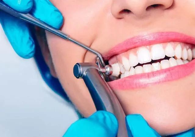 How Much Does Teeth Scaling and Polishing Cost? cover picture
