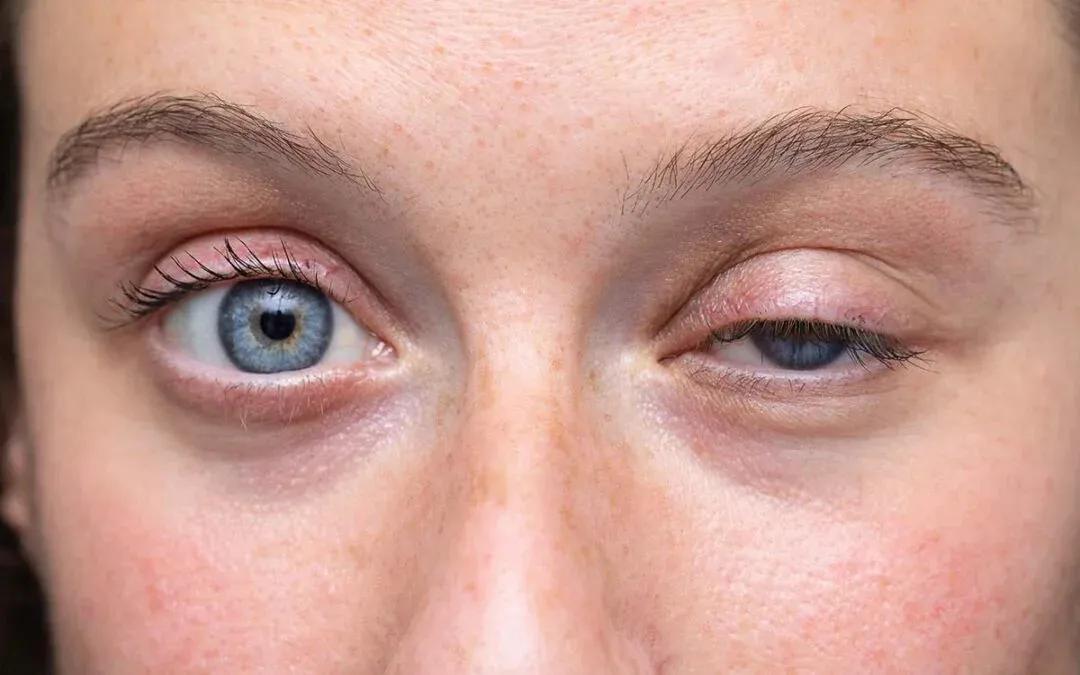 Eyelid Surgery South Africa: Comprehensive Eyelid Care in Cape Town cover picture
