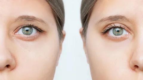 What Causes Drooping Eyebrows and How Can They Be Treated? cover picture