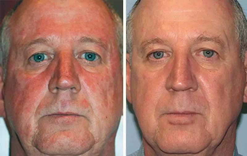 Laser Treatment Cape Town: BBL Hero vs A cover picture
