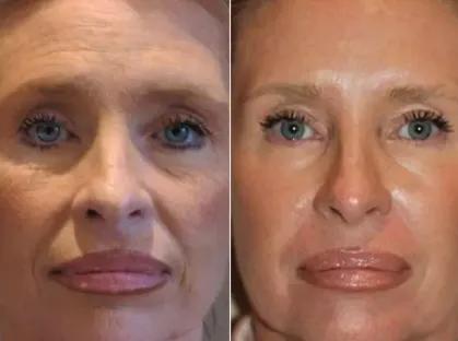 How Ablative Laser Resurfacing Improves Skin Texture and Reduces Scars cover picture