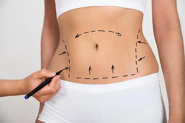 Can Liposuction Improve Body Shape Confidence? cover picture