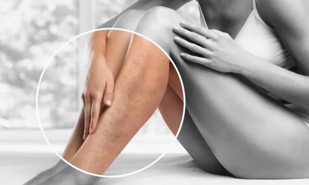 Does Sclerotherapy Improve Leg Appearance? cover picture