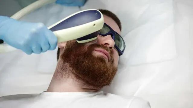 Does Beard Laser Hair Removal Work on Thick Hair? cover picture