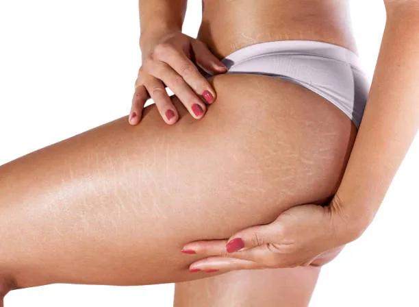 Can Stretch Mark Removal Improve Skin Texture? cover picture
