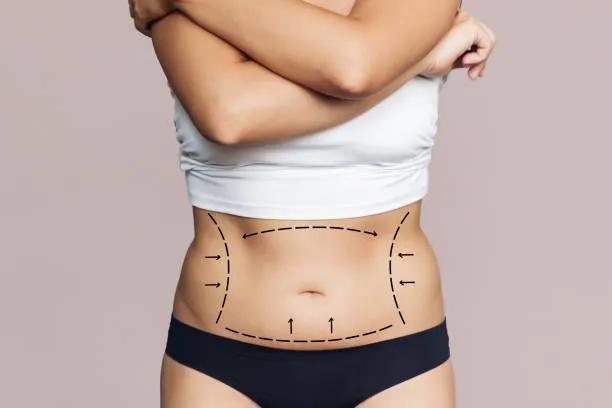How Lipo Abdominoplasty Shapes the Waistline ? cover picture