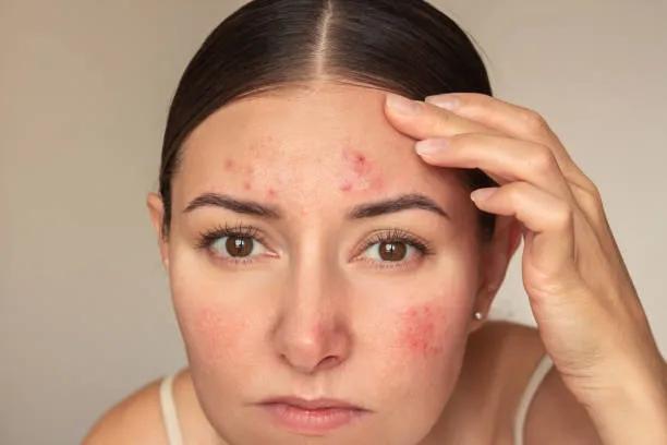 Is Acne Treatment Suitable for Darker Skin Tones? cover picture