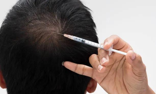Can Stem Cell Hair Transplant Treat Alopecia? cover picture