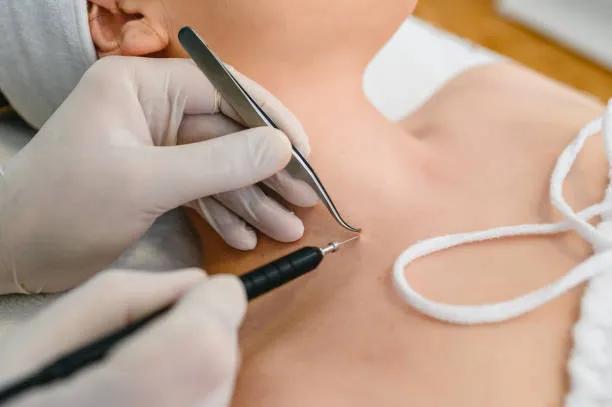 Is Mole Removal a Permanent Solution? cover picture