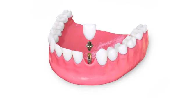 What Makes Dental Implants So Popular? cover picture