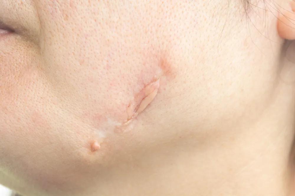 Does Facial Scar Revision Improve Skin Texture? cover picture
