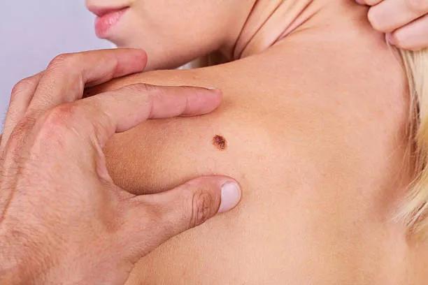 Which Areas Are Treated in Skin Tag Removal ? cover picture
