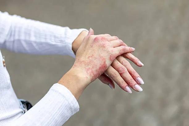 Can Eczema Treatment Stop Skin Peeling? cover picture