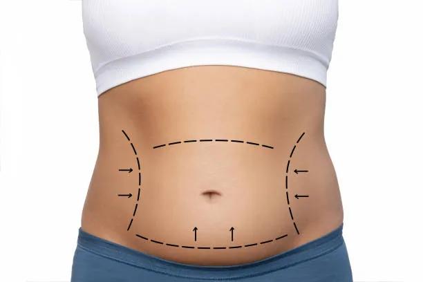 Is Liposuction Helpful for Lower Belly Fat? cover picture