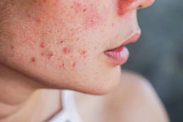 Can Acne Treatment Clear Pores and Blackheads? cover picture