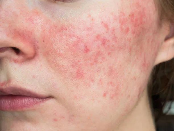 Can Laser Acne Scar Treatment Fade Dark Acne Spots? cover picture