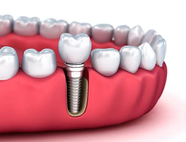 How Do Dental Implants Restore Bite Strength? cover picture