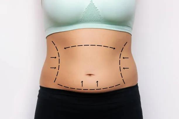 Can Liposuction Improve Body Confidence Quickly? cover picture